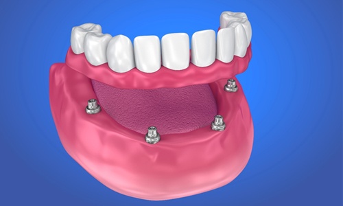 Model of implant-retained denture for lower arch