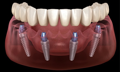 All-On-4 denture to treat complete tooth loss