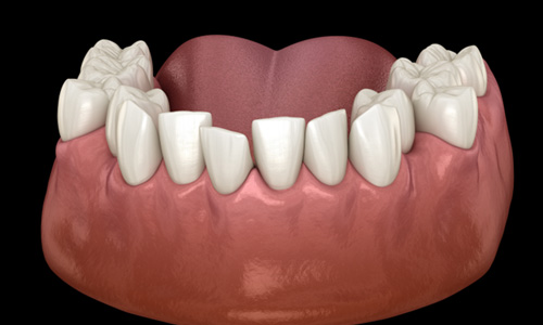 Illustration of crooked teeth