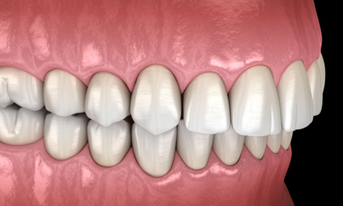 Illustration of an overbite