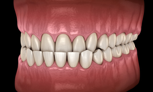 Illustration of an underbite