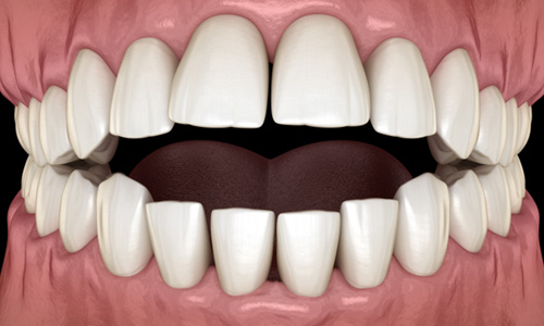 Illustration of an open bite