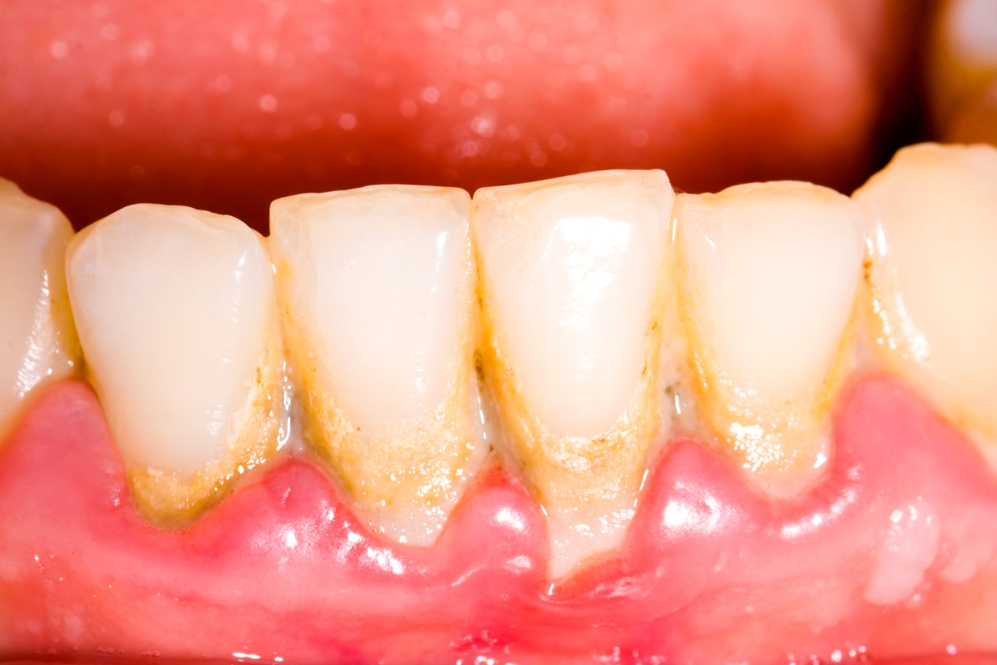 gingivitis-contagious-worcester-gum-disease-university-dental-group